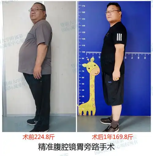 内脏脂肪堆积的将军肚,你知道这腹型肥胖的危害吗
