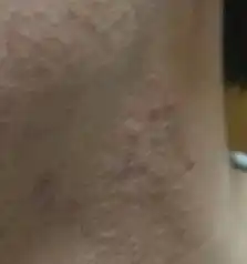 脖子上长痘痘是怎么回事
