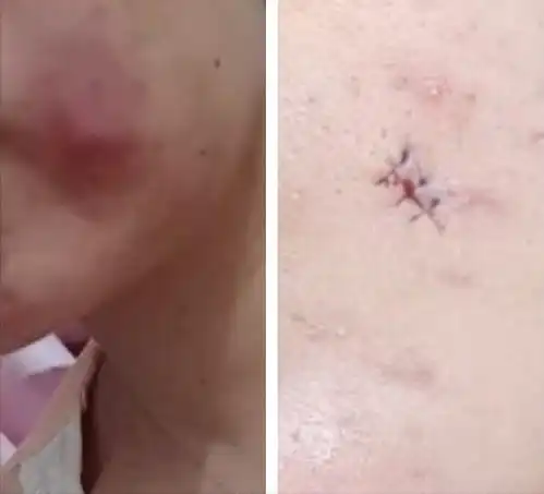 女子挤痘痘脸部感染手术缝6针是表皮样囊肿,花了一年时间才解决
