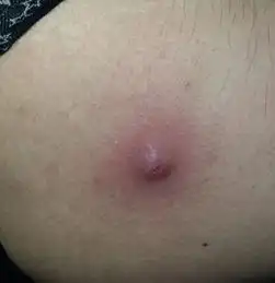 大腿上长了一个类似脓包的东西