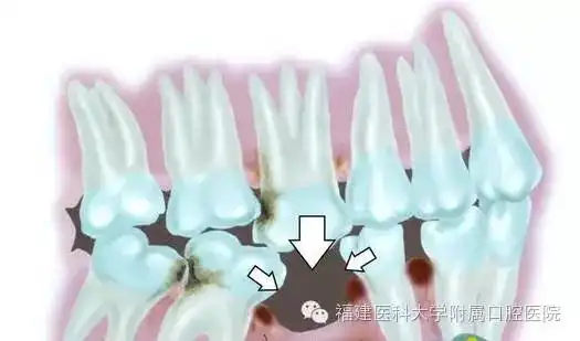 20181106百会口腔医生,请把我的牙做得好一点,我要啃骨头吃花生