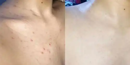 前胸后背和脖子都长了这种痘痘怎么办而且很多看起来整个背都是