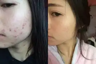 秘显微镜下的痘痘,一个痘痘200条虫长痘必看.......