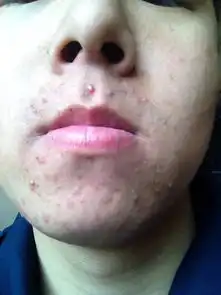 下巴很长痘痘怎么回事怎么引起的,该怎样治疗