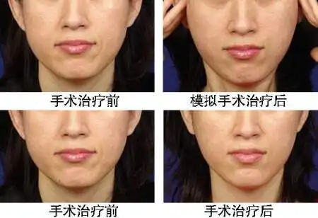 面部除皱