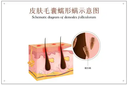 屁股上长痘是什么情况4个预防毛囊炎的方法,让你不再长痘