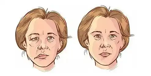 你真的了解面神经麻痹吗听听专家怎么说