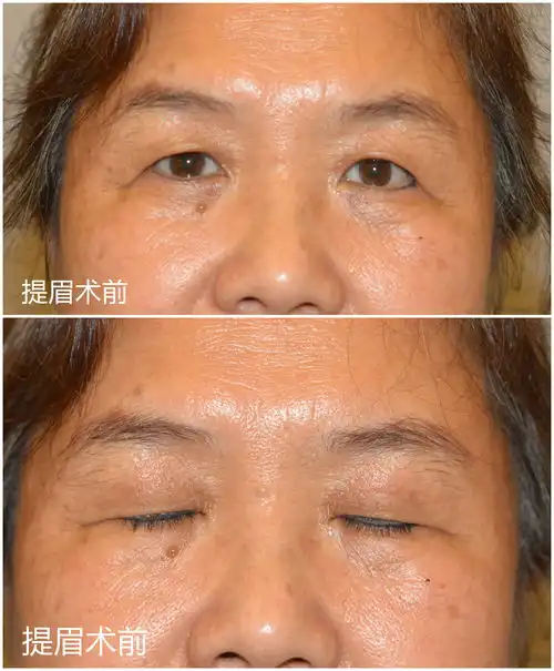 改善眼周衰老状态的提眉手术