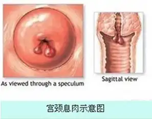 宫颈息肉患者有哪些异常症状