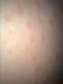 脸上胳膊上腿上屁股上脚上长了很多这样的痘痘,是不是过敏呀还是湿疹寻麻疹风疹之类的,吃氯雷他定片再涂