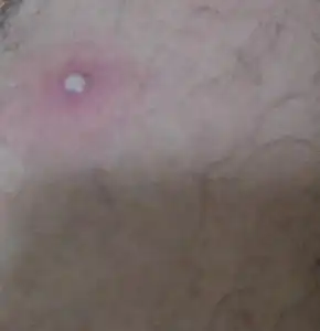 腿上长了这种脓包是什么原因,这在医学上见什么症状开始是这个地方慢慢肿起来,一两天后脓包就像这样了