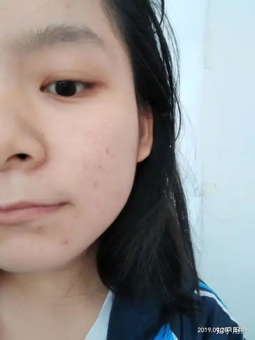 有没有长得好看但长痘痘的女生