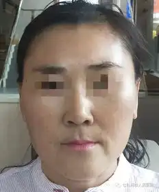 美丽不打褶旧貌换新颜市人民医院成功开展全市首例全面除皱新技术