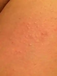 大腿上长了像鸡皮疙瘩一样的痘痘一到晚上就痒忍不住去抓皮肤然后那块就红还有很多鸡皮疙瘩一样的痘
