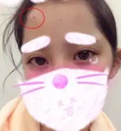 张馨予的痘痘长了一个月都没好祛痘还得向刘涛学习