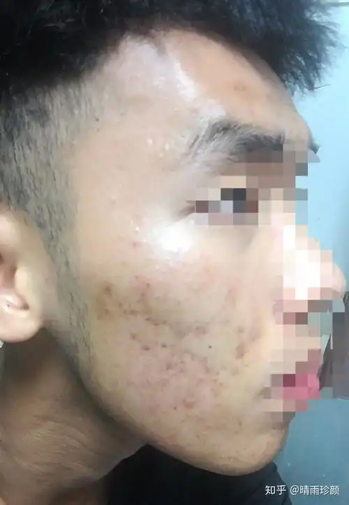 本人大一,痘痘从六年级就开始了,反反复复粉刺囊肿型痘痘,家里人不重视,自己也没钱去美容院怎么办