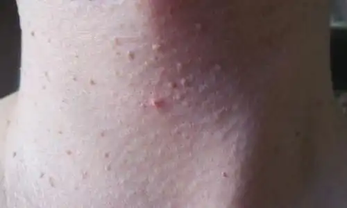 脖子腋下长出的小肉粒是什么会影响健康吗怎样才能去掉