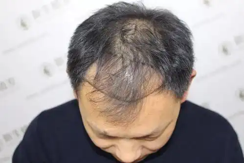 头发一把一把的掉,5个脱发原因,值得思考,你是否也在其中