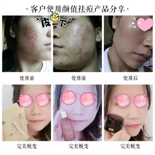 一个痘痘200条虫,长痘痘的脸原来那么脏,你有痘你先看.