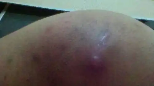 屁股上总是长疙瘩,硬硬的很疼头上慢慢会变软,很大有矿泉水瓶盖那么大,之前还因为这疙瘩做过手术,就是