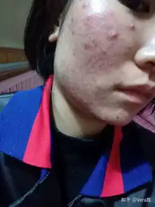 脓包型痤疮怎么治疗