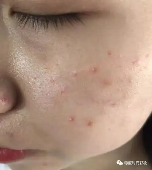 四个有效祛痘小妙招,针对不同的痘痘类型,一步到位