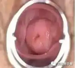 女性可怕的宫颈病变炎症糜烂囊肿息肉肥大防大于治呀