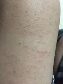 大腿上长类似痘痘的东西能挤出一粒粒白色东西这是什么病