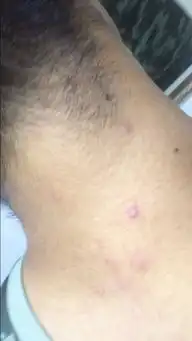 请问我脖子后面的痘痘是过敏吗在线等急呀可以用芦荟胶吗或者皮炎平吗