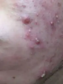 不知怎么回事,长了很多脓包型痘痘,需要刺破它把里面的脓放出来吗