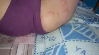 请问本人屁股长什么痘啊,这么大,多吓人啊是有什么疾病吗