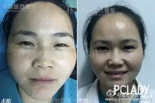 女性面部除皱的方法有哪些