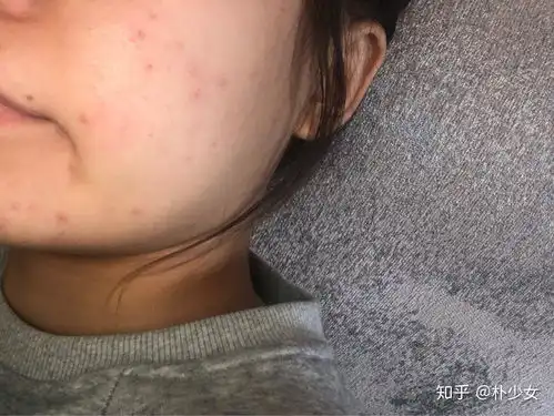 我的皮肤日志