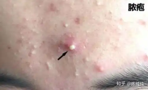 脸上痘痘为啥一直好不了