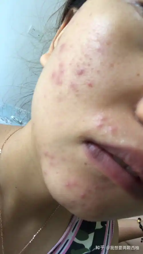 反复长痘怎么治痘痘好不了了吗