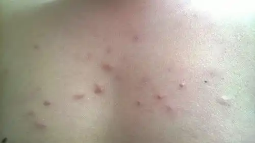 皮肤上的痘痘到底是什么,不疼不痒,就是特别硬,胸前,和肩膀上都有,我是男的,呵呵,传个两张图片,麻烦懂的人看看