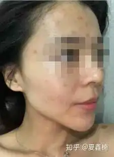 表情你知道你为什么一直反复长痘痘吗表情