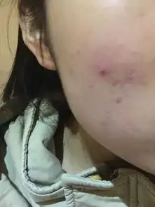 脓包型痘痘挤还是不挤不挤的话他不会下去,挤的话每次都会留印怎么办