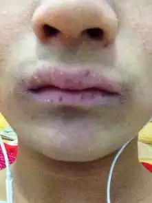 嘴唇上长黑点什么原因