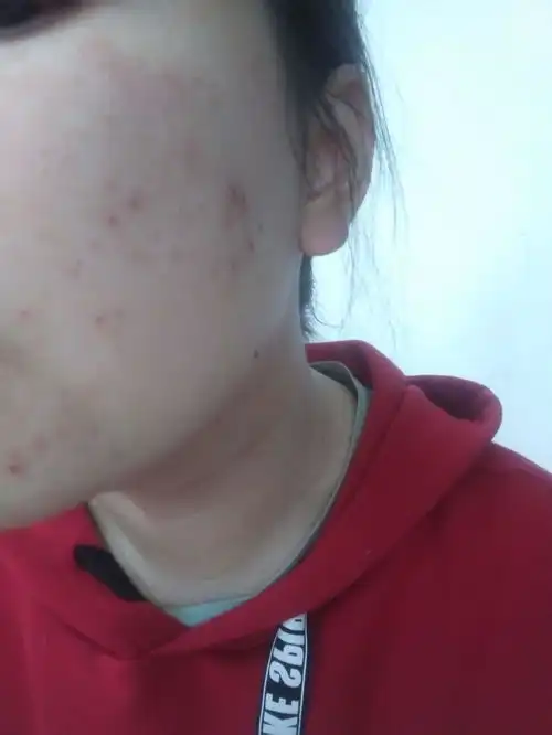我是大学女生,油皮痘肌敏感肌,有什么牌子的护肤品推荐