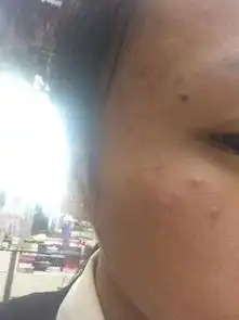 为什么总在太阳穴长大浓包,不像痘痘,都是好久不消的那种,用挤然后就这么多坑了怎么回事谁知道什么原