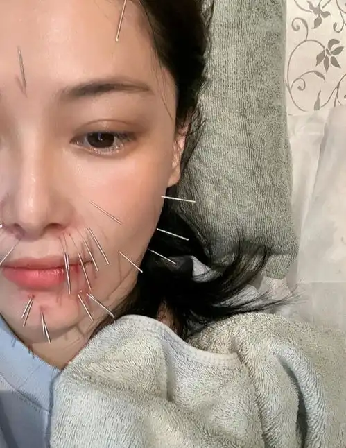 张馨予到重庆商演,恰逢长了青春痘不仅没有吃上火锅还扎了20针
