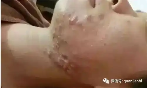 二十三岁的女孩脸上很多痤疮脓包,中医西医全都看过效果不大权健秘方调理一个月后自信满满