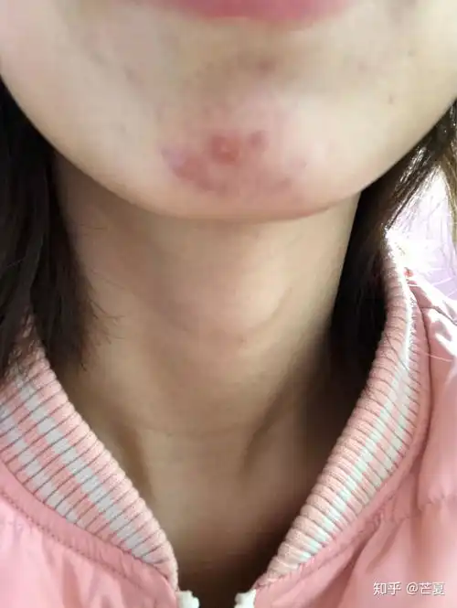 有没有小伙伴下巴长过这种痘痘啊这是什么类型的痘痘啊我要哭了总是反反复复的长很痛很肿