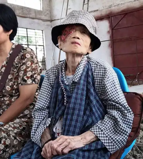 因果报应太可怕一名80多岁的老太太脸上长严重的人面疮,太吓人有图有真相