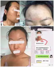 知乎显微镜下的痘痘,一个痘痘200条虫长痘必看.......