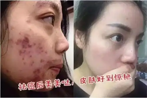 一个痘痘200条虫,长痘痘的脸原来那么脏,你有痘你先看......