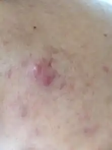 痘痘长成脓包了怎么办