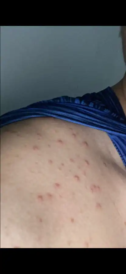肩膀和胸口长了一片红痘痘不疼不痒的怎么回事