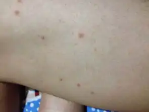 腿上长小痘痘的不知道是什么,